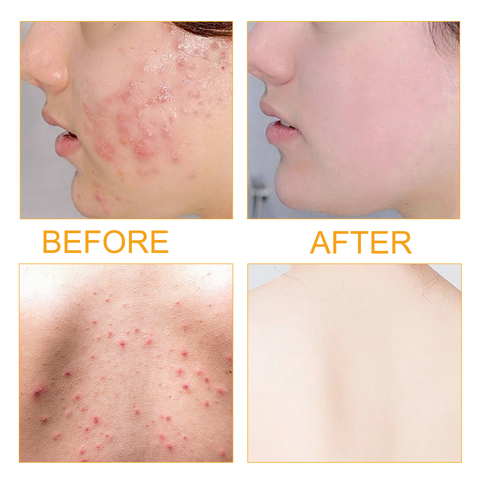 51ea8669 02e3 4b1d a7bd 6845443d6170.jpg Clear Skin Serum: Reduce Acne & Marks with Moisture